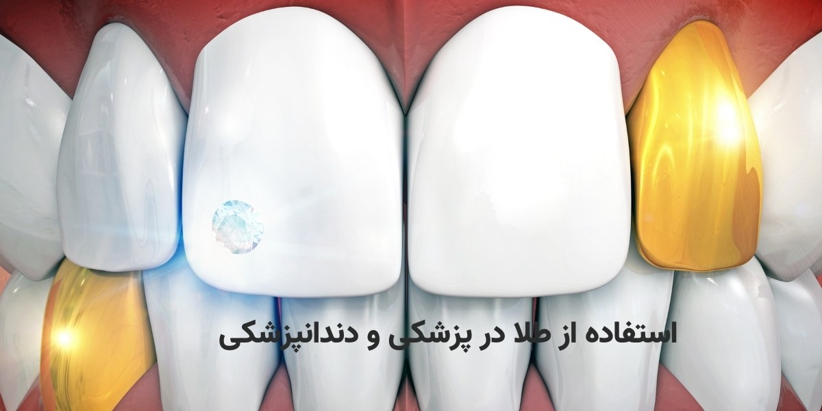 استفاده از طلا در دندانپزشکی